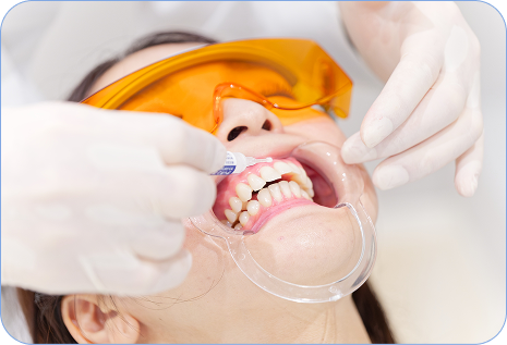 ホワイトニング施術の様子