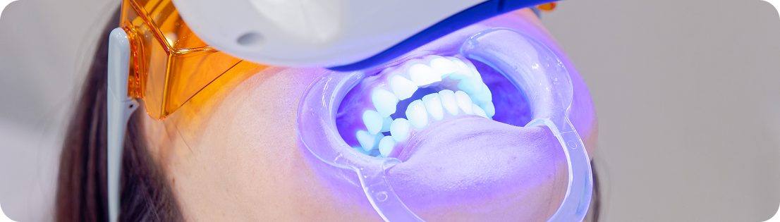 オフィスホワイトニング